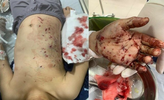 H&igrave;nh ảnh c&aacute;c tổn thương của bệnh nhi sau nổ pin đồ chơi.