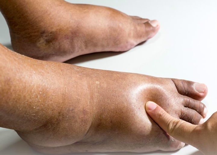 Cảnh Báo Những Dấu Hiệu Bệnh Tiểu Đường Ở Chân