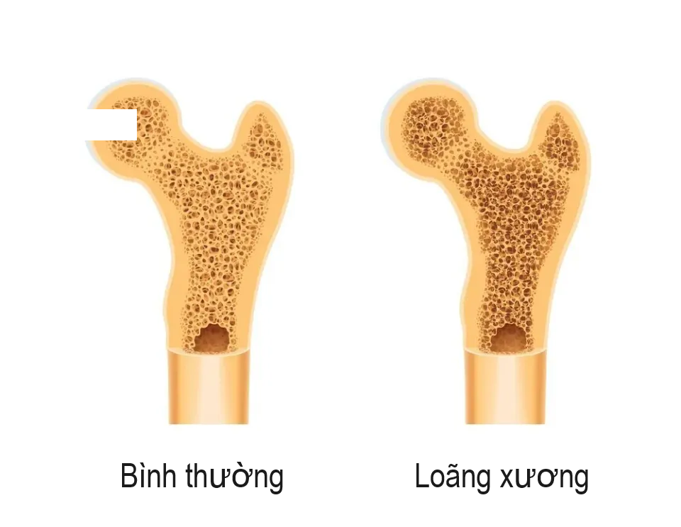 Thói quen nấu nướng nhiều người mắc đang "rút cạn" xương trong cơ thể bạn