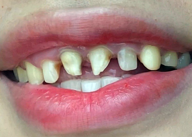 Miệng hôi, răng ê buốt không ăn, không ngủ được vì bọc răng sứ vô tội vạ