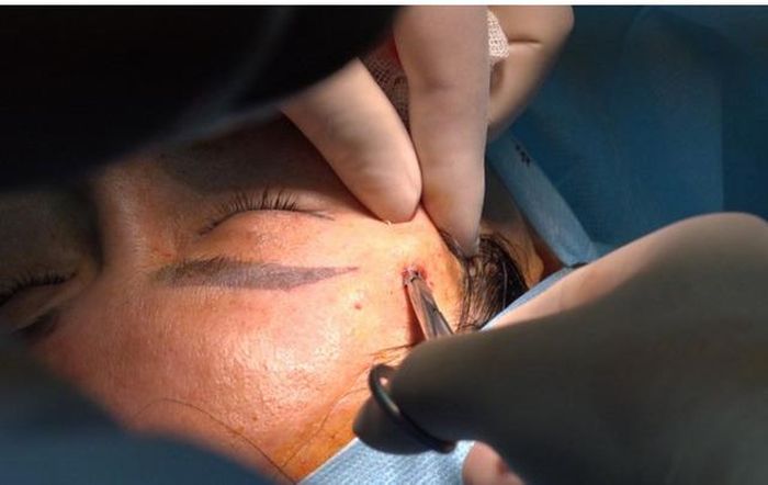 Nguy cơ đột quỵ, mù mắt sau tiêm filler làm đẹp