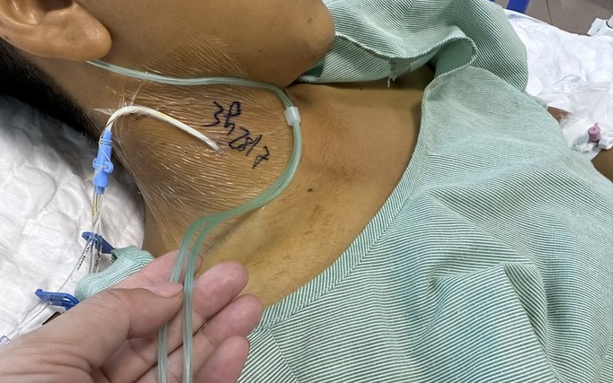 Ăn xôi có phẩm màu, nam thanh niên ngộ độc suy đa tạng