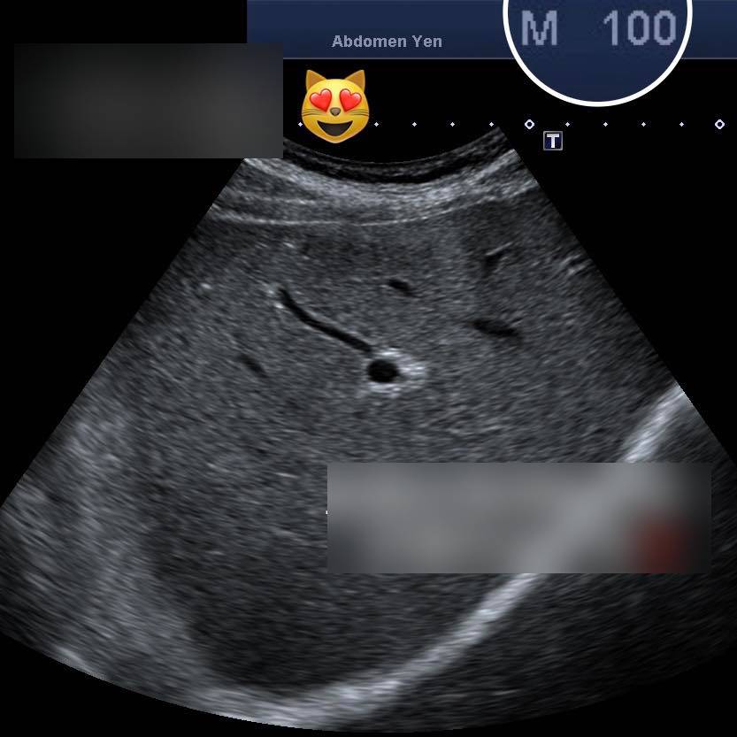 Cụ ông trăm tuổi nhưng gan khỏe mạnh như thanh niên nhờ thực phẩm quen thuộc, bác sĩ chỉ ra 3 dưỡng chất giúp gan "trẻ hóa"