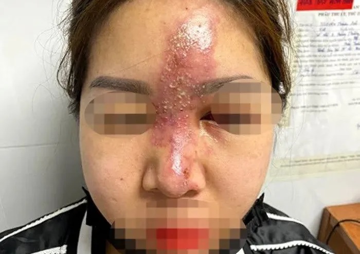 Chuyên gia cảnh báo biến chứng làm đẹp dịp cận Tết