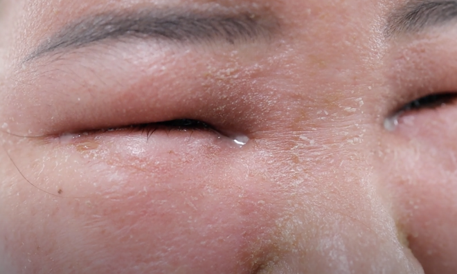 2523-nguoi-phu-nu-phai-nhap-vien-do-tu-peel-da-tai-nha-001_66e072fc8d028.webp