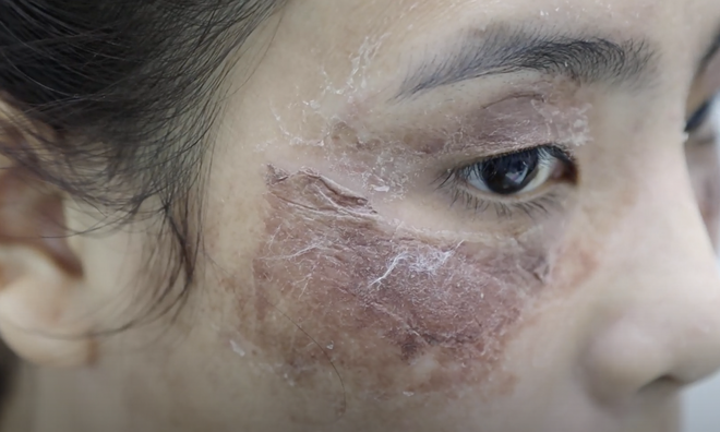 2524-nguoi-phu-nu-phai-nhap-vien-do-tu-peel-da-tai-nha-002_66e073038e5ba.webp peel da