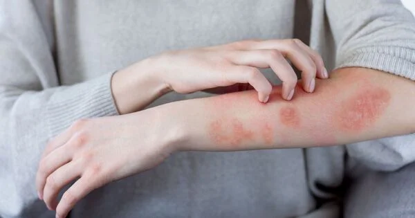 Trời cứ mưa mưa nắng nắng, cần đề phòng bệnh về da nào?