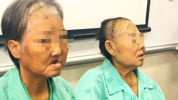 Bệnh lạ gây hoại tử hàm và sọ mặt hậu nhiễm Covid