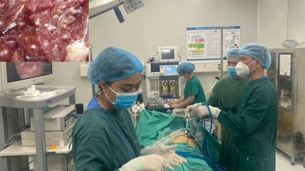 Cảnh báo: Có thể thủng ruột nếu ăn thịt lợn nhiễm bệnh