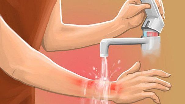 Các bước trị bỏng không để lại sẹo