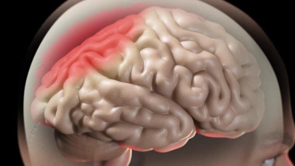 Uống rượu dù lượng vừa phải vẫn có thể khiến não bị lão hóa nhanh