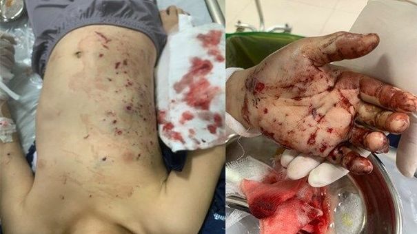 Pin đồ chơi phát nổ, bé 10 tuổi ở Quảng Ninh phải nhập viện