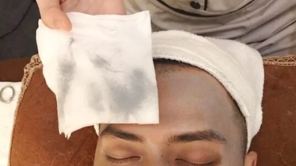 Hút chì thải độc cho da: 'Chiêu trò' câu khách!