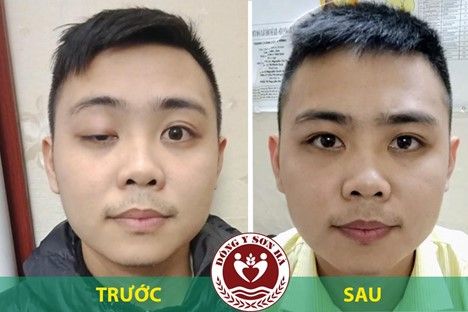 Tự nhiên sụp mí mắt phải làm sao?