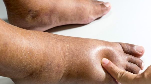 Cảnh Báo Những Dấu Hiệu Bệnh Tiểu Đường Ở Chân