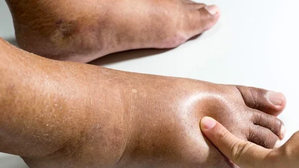 Cảnh Báo Những Dấu Hiệu Bệnh Tiểu Đường Ở Chân