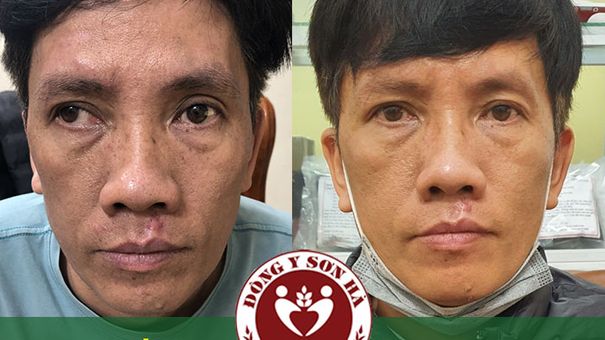 Tại sao mắt bị lác ngoài? Cách điều trị?