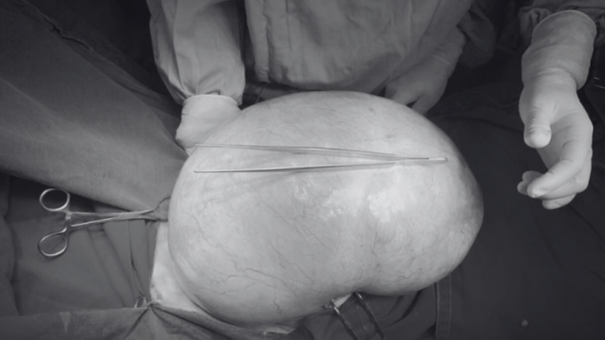 Cô Gái Tưởng Mình Bị Béo Bụng Ai Ngờ Mang Khối U 10kg