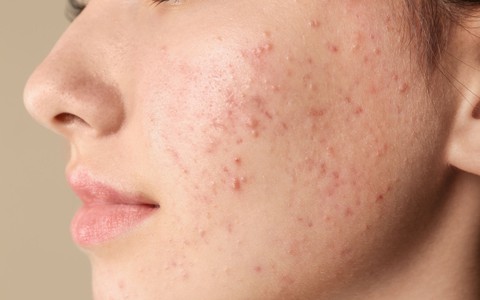Các Bạn Trẻ Sử Dụng Mỹ Phẩm Quá Sớm Và Những Hệ Lụy Cho Làn Da