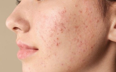 Các Bạn Trẻ Sử Dụng Mỹ Phẩm Quá Sớm Và Những Hệ Lụy Cho Làn Da