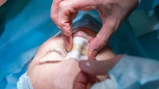 Bị hoại tử mũi vì để nha sĩ phẫu thuật thẩm mỹ