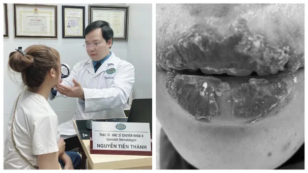 Bé gái 15 tuổi có nguy cơ sẹo vĩnh viễn do xăm môi hỏng
