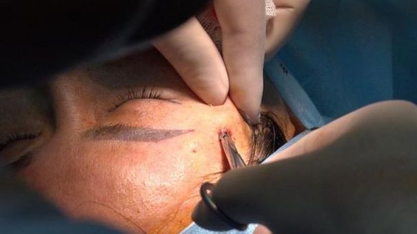 Nguy cơ đột quỵ, mù mắt sau tiêm filler làm đẹp
