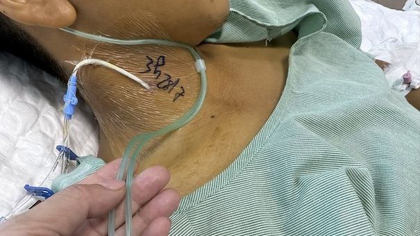 Ăn xôi có phẩm màu, nam thanh niên ngộ độc suy đa tạng