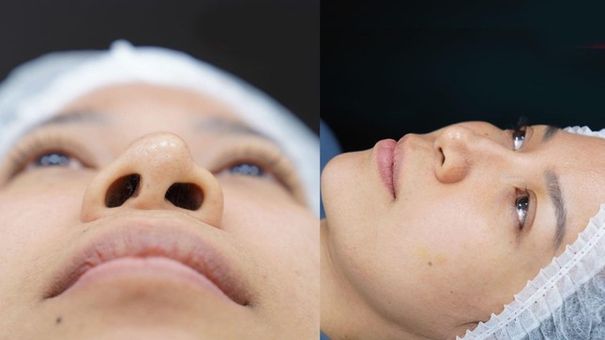 Biến Chứng Nâng Mũi Tại Các Spa Kém Chất Lượng Có Sửa Được Không