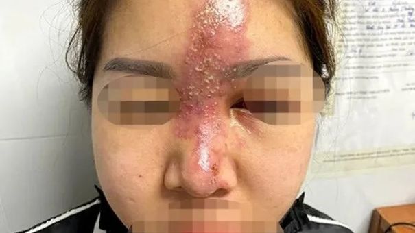 Chuyên gia cảnh báo biến chứng làm đẹp dịp cận Tết