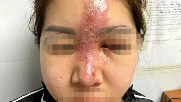 Chuyên gia cảnh báo biến chứng làm đẹp dịp cận Tết