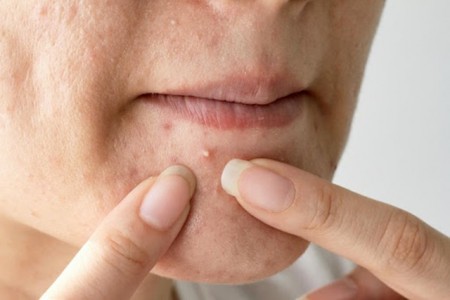Lý Do Mụn Mọc Nhiều Ở Cằm
