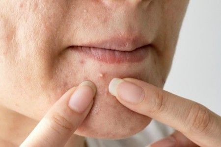 Lý Do Mụn Mọc Nhiều Ở Cằm