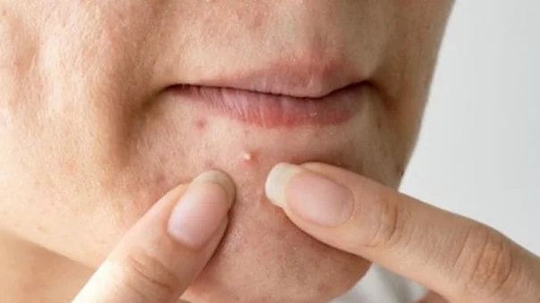 Lý Do Mụn Mọc Nhiều Ở Cằm