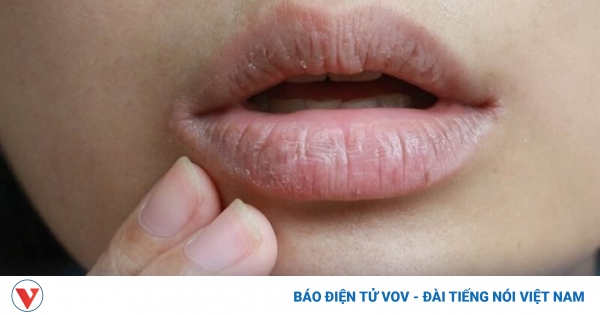Khô miệng có thể là “báo động đỏ” cho 5 căn bệnh nguy hiểm mà bạn chưa biết