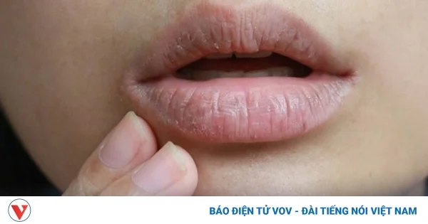 Khô miệng có thể là “báo động đỏ” cho 5 căn bệnh nguy hiểm mà bạn chưa biết