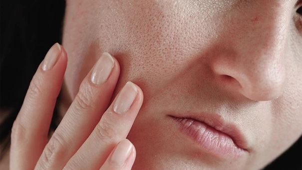 Nên làm gì khi lỗ chân lông to?