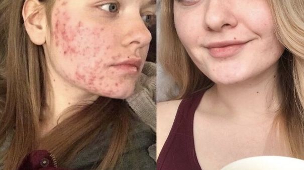 Những Thực Phẩm Này Có Thể Là Tác Nhân Gây Mụn Cho Các Chị Em