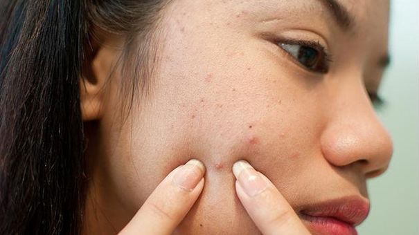 Mách Chị Em Cách Nặn Mụn Không Để Lại Sẹo