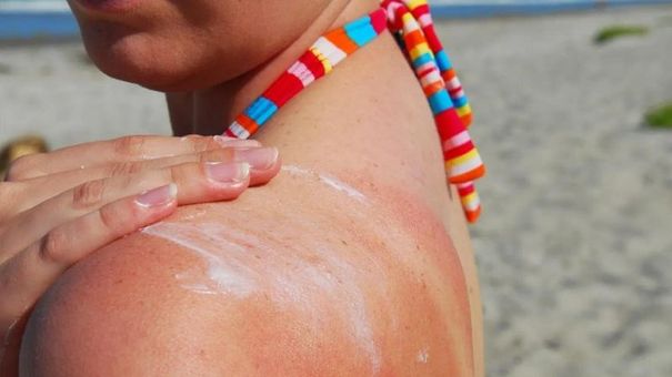 Mẹo Xử Lý Khi Da Bị Cháy Nắng