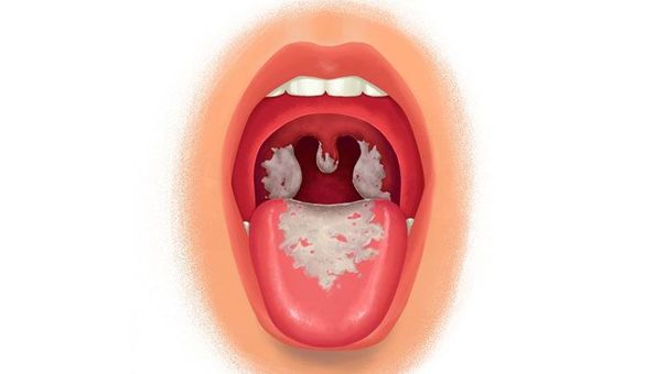 Bệnh Bạch Hầu Lây Nhiễm Như Nào Và Phòng Tránh Ra Sao?