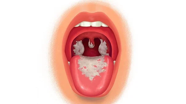 Bệnh Bạch Hầu Lây Nhiễm Như Nào Và Phòng Tránh Ra Sao?