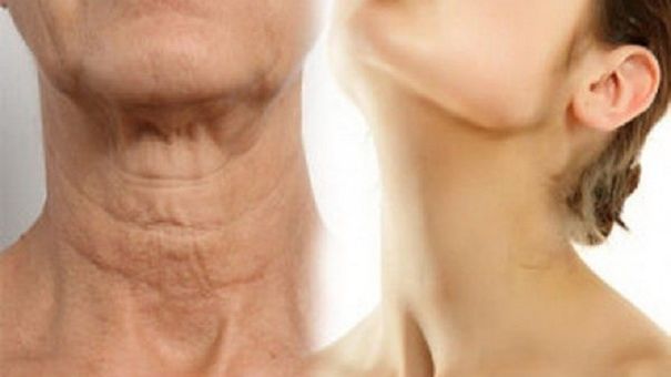 Cách Để Loại Giảm Nếp Nhăn Ở Cổ