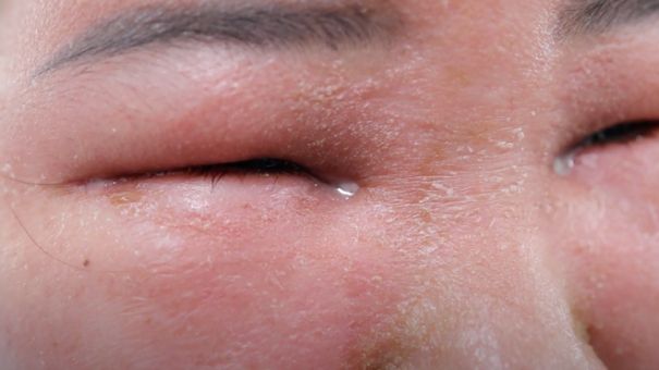 Người Phụ Nữ Phải Nhập Viện Do Tự Peel Da Tại Nhà