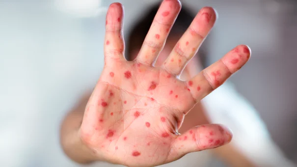 Người Bị Bệnh Sởi Có Nên Tắm Không