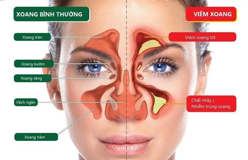Hình ảnh viêm xoang.