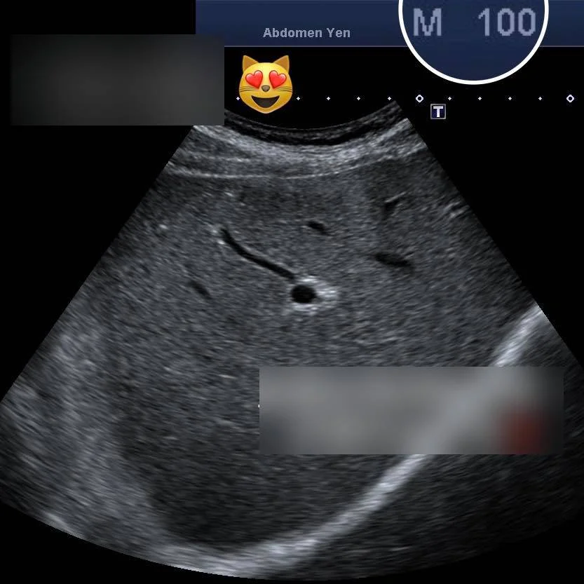 Cụ ông trăm tuổi nhưng gan khỏe mạnh như thanh niên nhờ thực phẩm quen thuộc, bác sĩ chỉ ra 3 dưỡng chất giúp gan "trẻ hóa"